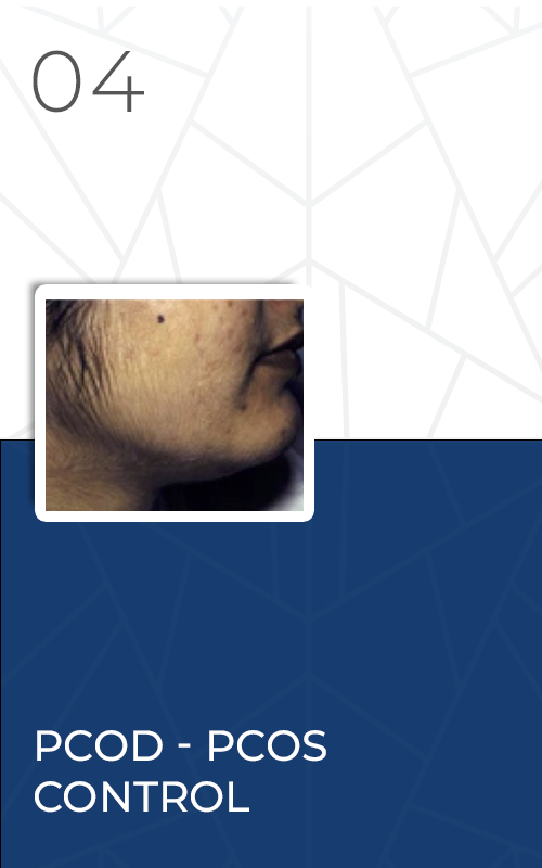dc43-dpd-pcod-pcos